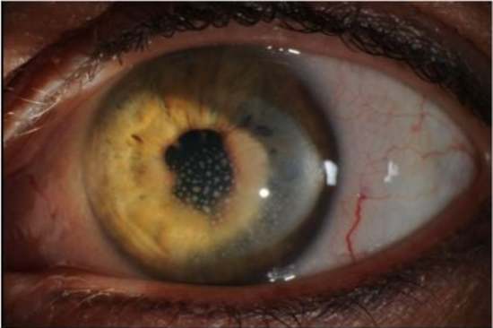 عملية تفتيح العيون بـ”الليزر“: هل هي آمنة؟